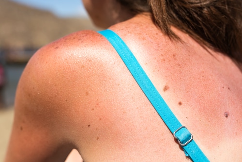 Sunburn,From,Beach,Sun,Light,On,The,Shoulder,And,Back